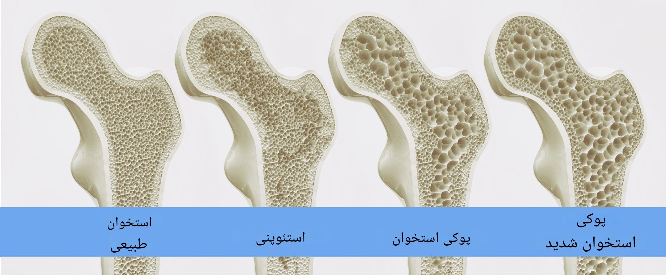 مراحل پوکی استخوان