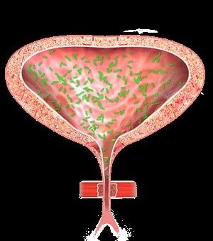عفونت مثانه یا سیستیت