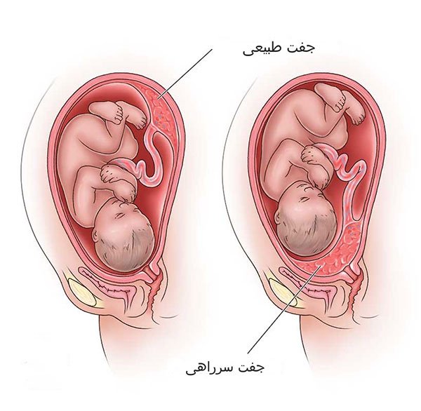 جفت سرراهی یا پرویا