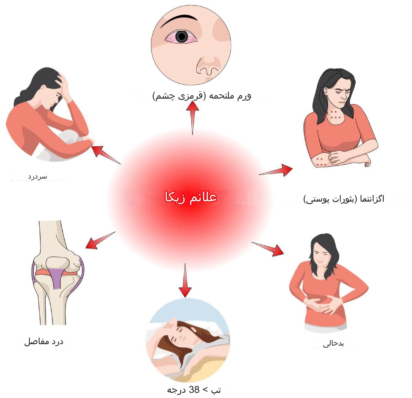 علایم ویروس زیکا