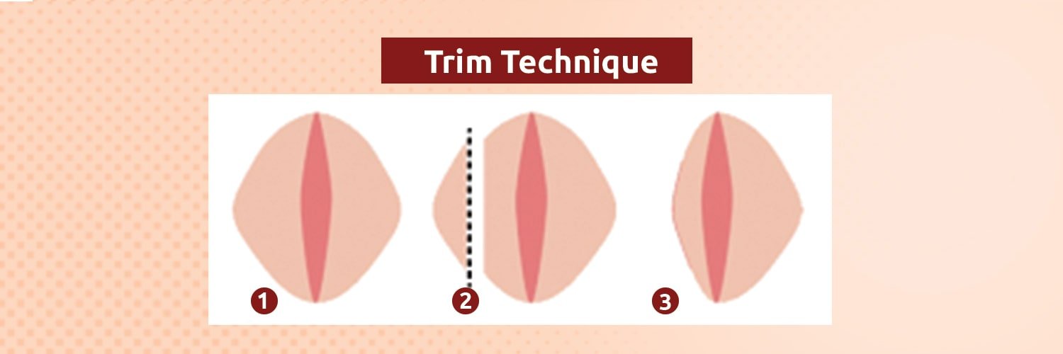 تکنیک تریم در لبیاپلاستی