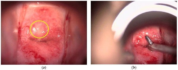 انجام بیوپسی در کولپوسکوپی