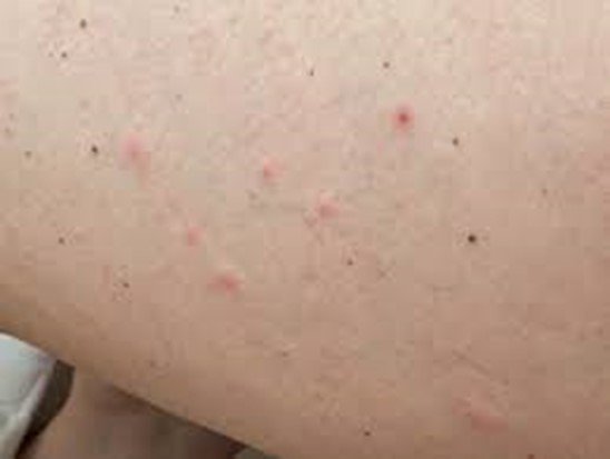 خارش بارداری 