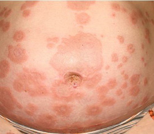 پمفیگوئید حاملگی 