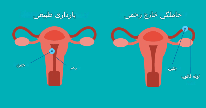 حاملگی خارج رحمی چیست