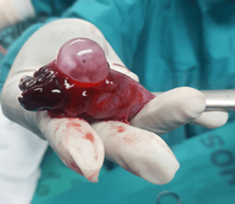   خطرات احتمالی جراحی حاملگی خارج از رحم