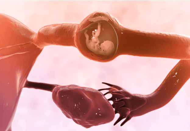 بارداری خارج از رحم 