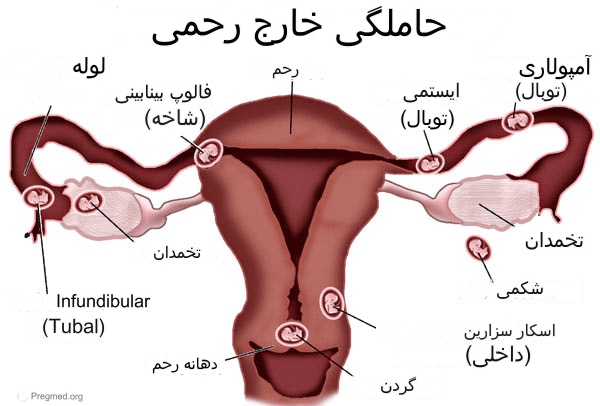 محل های حاملگی خارج از رحم 