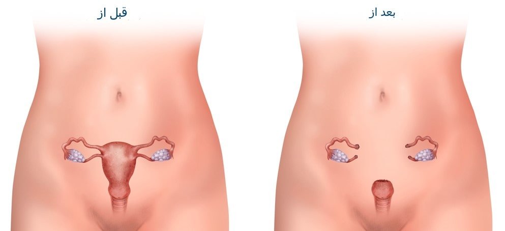 هیسترکتومی