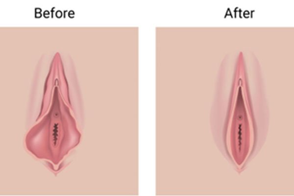 لابیاپلاستی