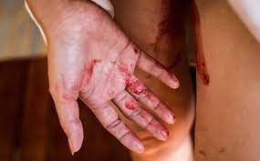 خونریزی شدید پریودی