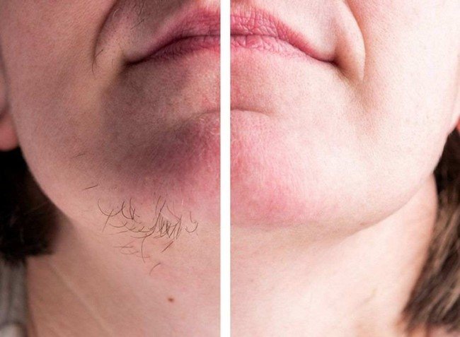 تشخیص سندرم تخمدان پلی کیستیک