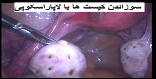 درمان لاپاراسکوپی  سندرم تخمدان پلی کیستیک یا تنبلی تخمدان