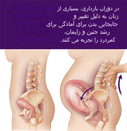 عضلات شکم چه نقشی در کمردرد  بارداری