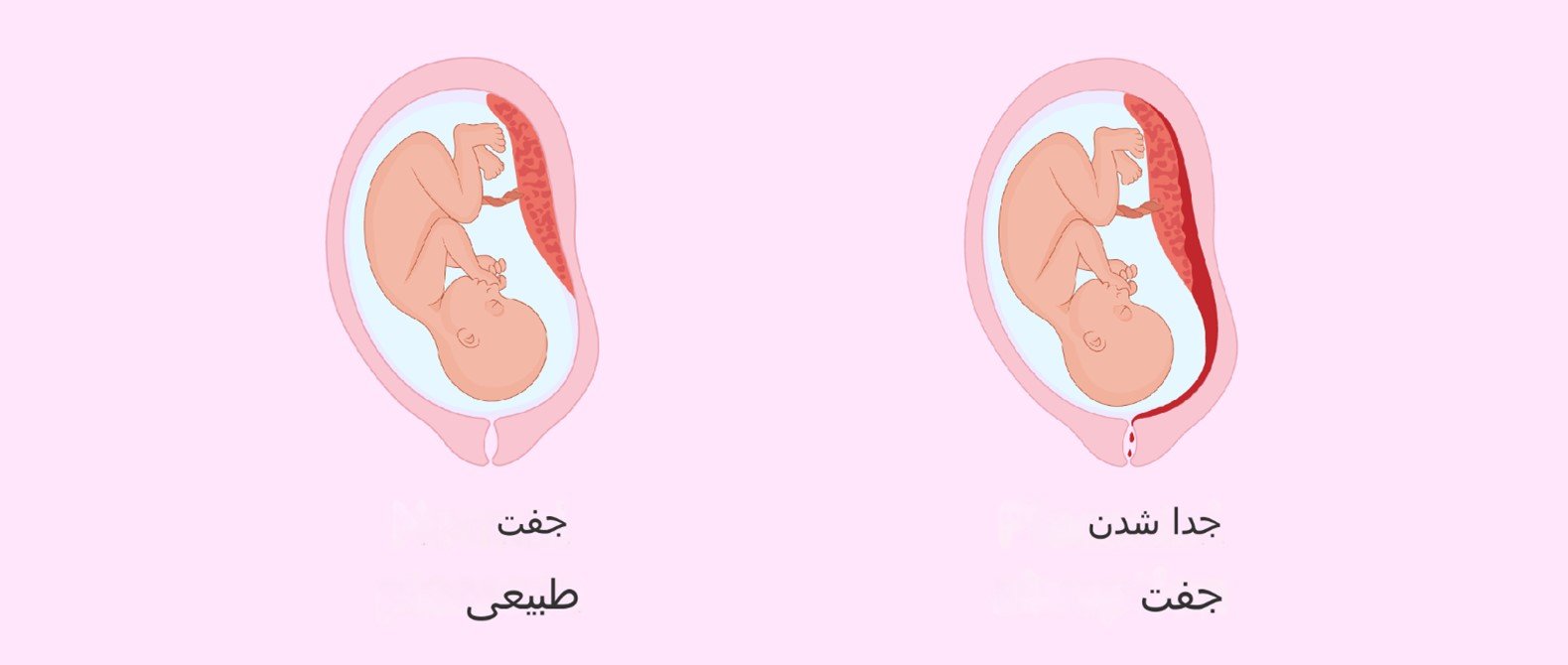 جداشدگی جفت 