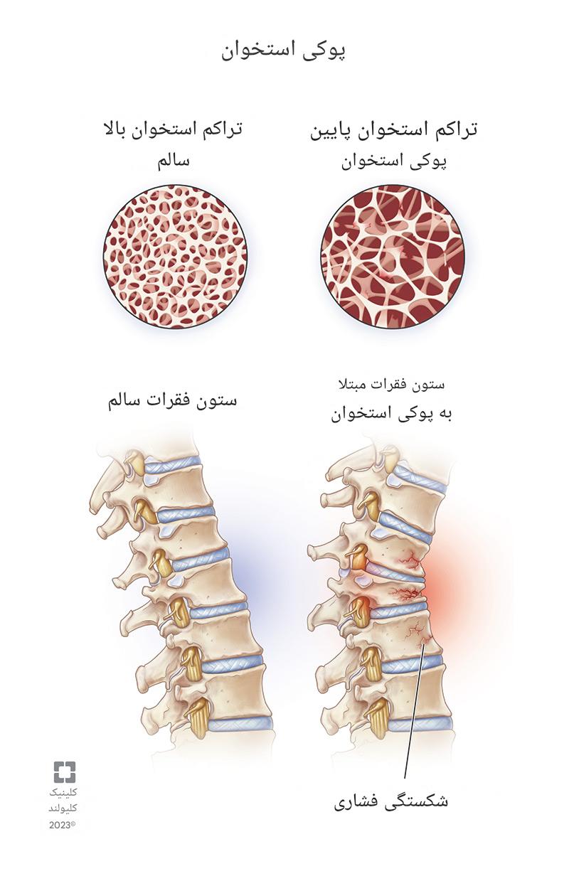 شکستگی در ستون فقرات