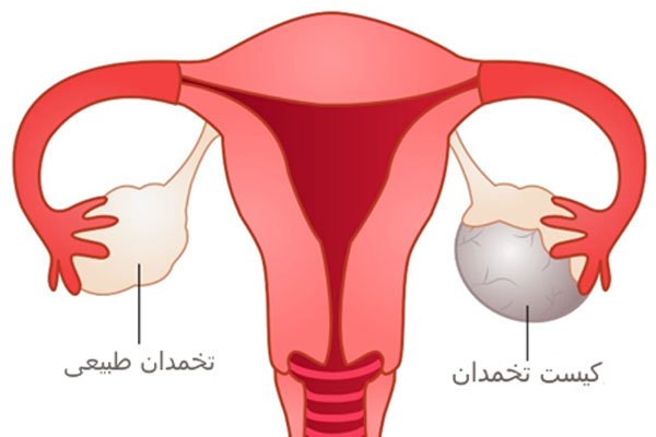 کیست تخمدان