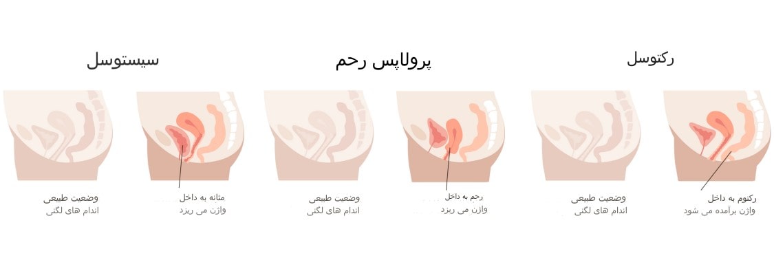 انواع مختلف افتادگی لگن