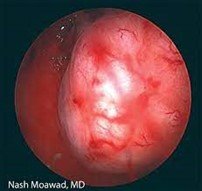 هیستروسکوپی فیبروم