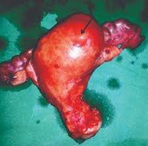 هیسترکتومی به دلیل فیبروم