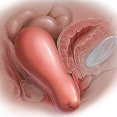 شکل افتادگی رحم به داخل واژندر زنان