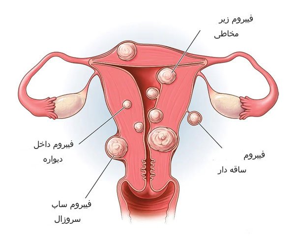 انواع مختلف فیبروم یا میوم رحم