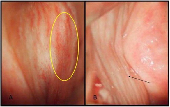 واژینیت غیر عفونی